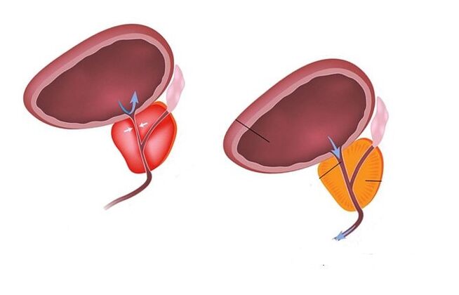 prostata osasuntsua eta gaixoa