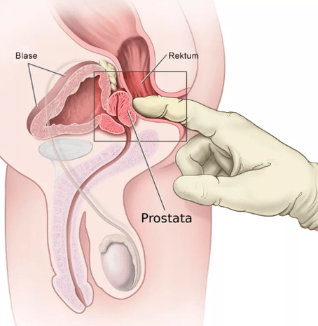 Prostatako masaje